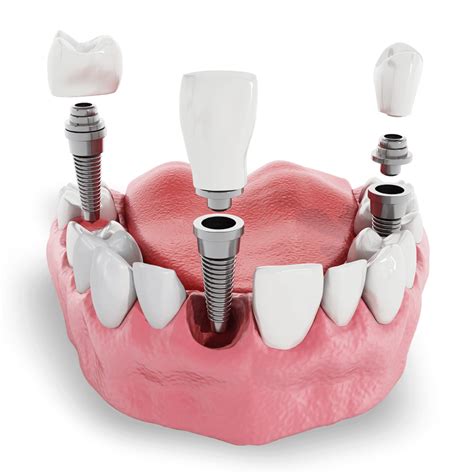 Tooth Extractions in Greensburg, PA .